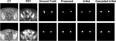 Lesion segmentation on 18F-fluciclovine PET/CT images using deep learning